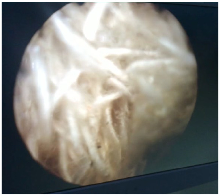 Intravesical Textiloma: A Rare Complication Following Laparoscopic Inguinal Hernia Repair - A Case report.
