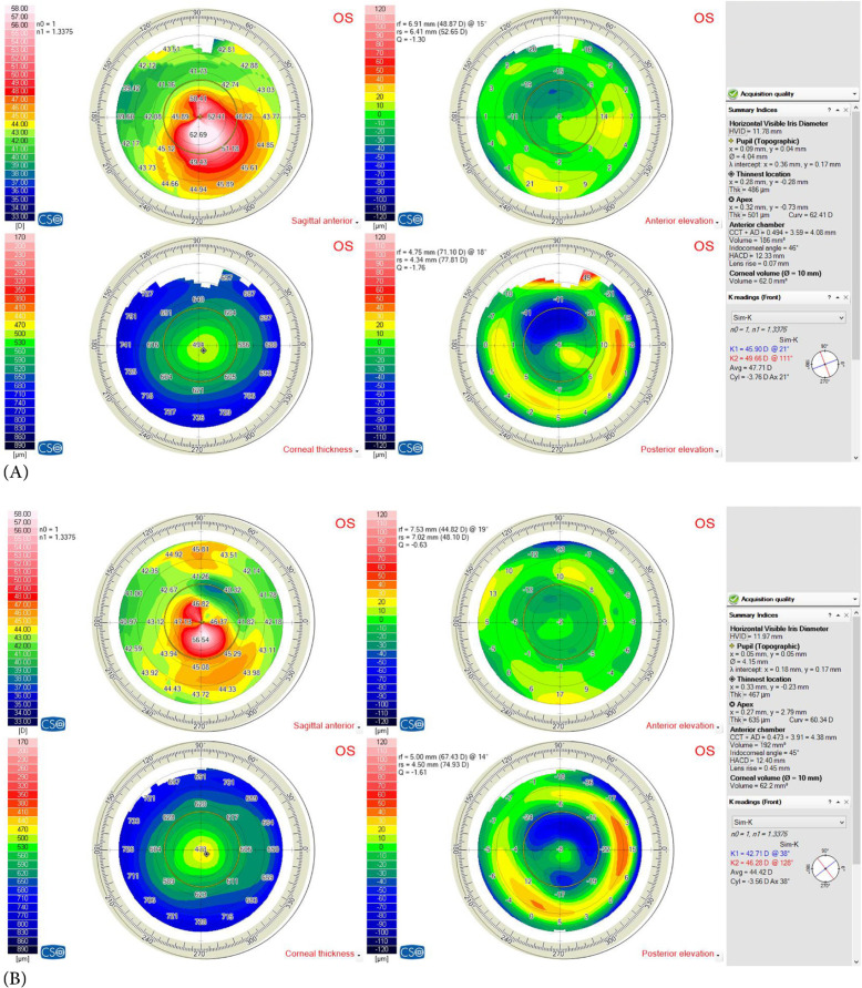 Outcomes of the Q value-based nomogram in managing pediatric versus adult keratoconus: a prospective interventional study.
