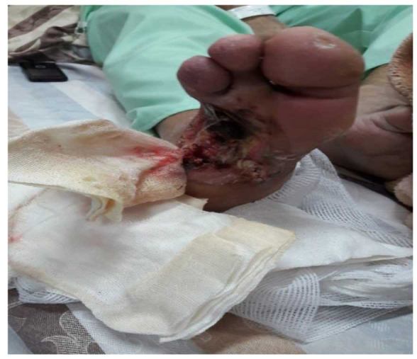 Clinic-mycological spectrum of <i>Candida</i> infection in diabetic foot ulcers in a tertiary care hospital.