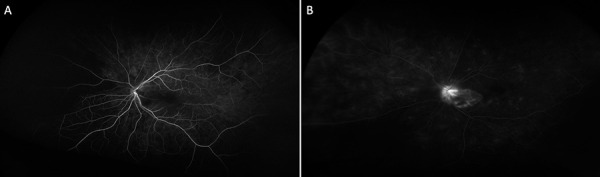 Calciphylaxis, beware the ophthalmic mimic: A case series.