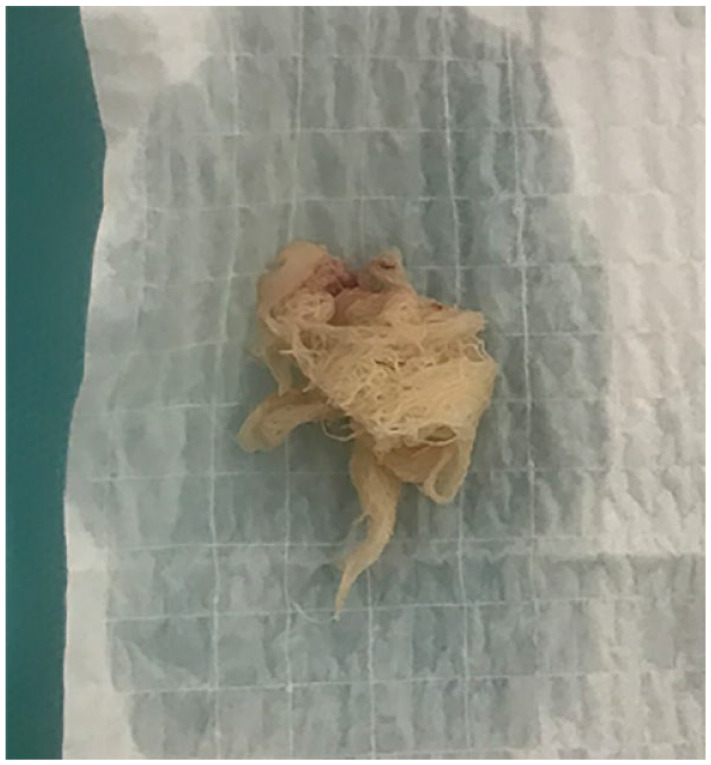 Intravesical Textiloma: A Rare Complication Following Laparoscopic Inguinal Hernia Repair - A Case report.