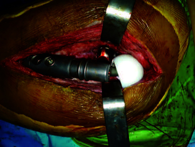 Reduction of the Femoral Head First, and Assembly of the MUTARS<sup>®</sup> Device in Case of Impossible Reduction during Total Hip Arthroplasty.