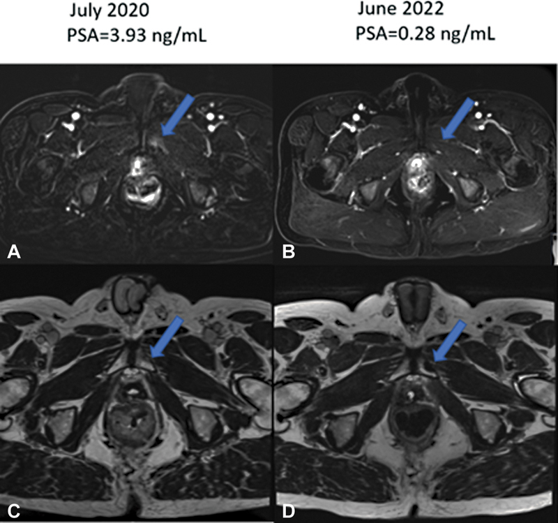 Prostate Cancer Skeletal Metastasis: A Spontaneous Evolution from Osteolytic to Osteoblastic Morphology without Treatment.