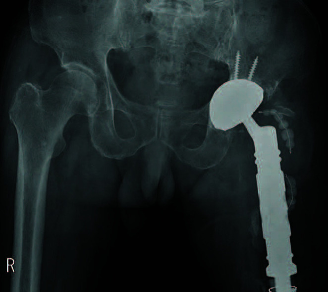Reduction of the Femoral Head First, and Assembly of the MUTARS<sup>®</sup> Device in Case of Impossible Reduction during Total Hip Arthroplasty.