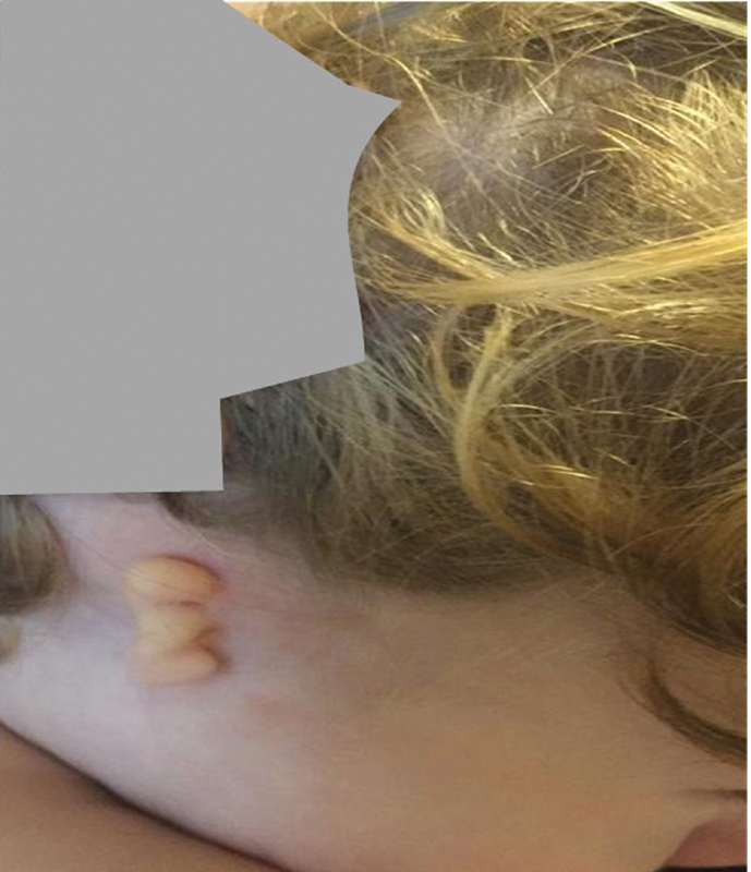 Severe Unilateral Microtia with Aural Atresia, Hair White Patch, Stereotypes in a Young Boy with De novo 16p13.11 Deletion: Reasons for a New Genotype-Phenotype Correlation.