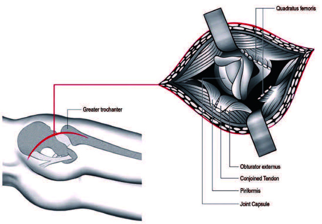 Change of Symptoms after Total Hip Arthroplasty in Patients with Hip-Spine Syndrome.