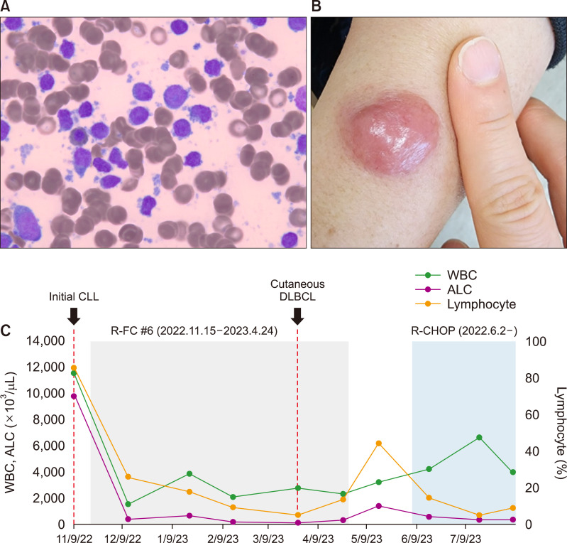 <i>TP53</i> mutation is a high-risk factor for Richter's syndrome based on circulating tumor DNA.