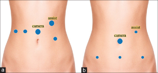 Robot-Assisted versus Laparoscopic Surgery for Pelvic Lymph Node Dissection in Patients with Gynecologic Malignancies.