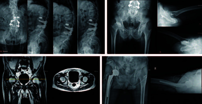 Change of Symptoms after Total Hip Arthroplasty in Patients with Hip-Spine Syndrome.