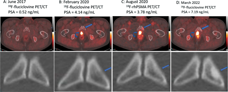 Prostate Cancer Skeletal Metastasis: A Spontaneous Evolution from Osteolytic to Osteoblastic Morphology without Treatment.
