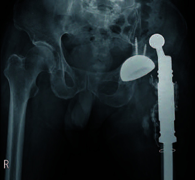 Reduction of the Femoral Head First, and Assembly of the MUTARS<sup>®</sup> Device in Case of Impossible Reduction during Total Hip Arthroplasty.