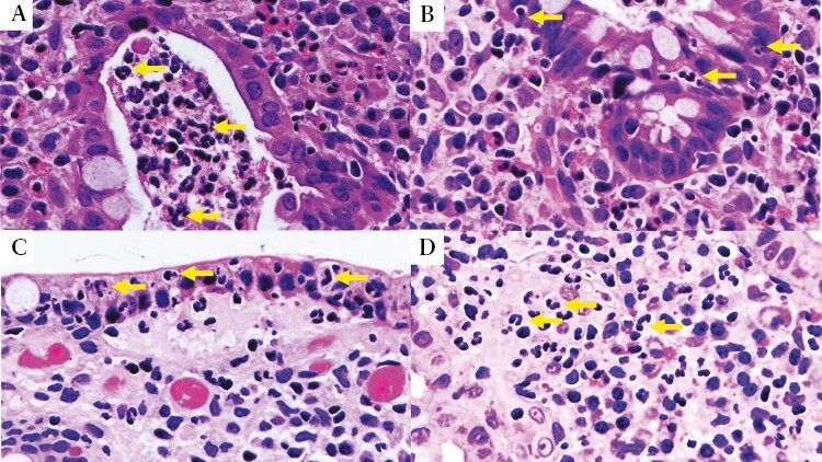 Neutrophil-only Histological Assessment of Ulcerative Colitis Correlates with Endoscopic Activity and Predicts Long-term Outcomes in a Multicentre Study.