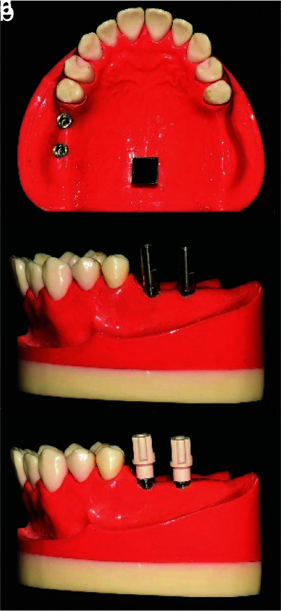 Effect of Repeated Use of Different Types of Scan Bodies on Transfer Accuracy of Implant Position.
