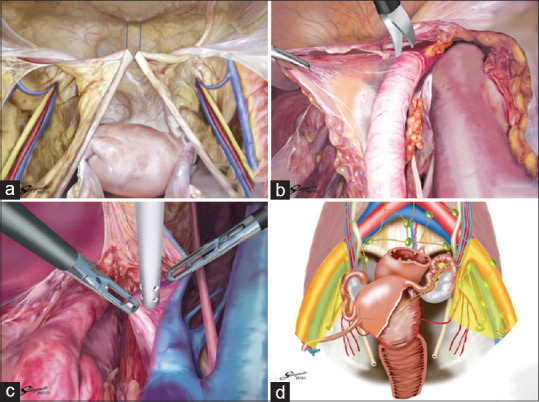 Robot-Assisted versus Laparoscopic Surgery for Pelvic Lymph Node Dissection in Patients with Gynecologic Malignancies.