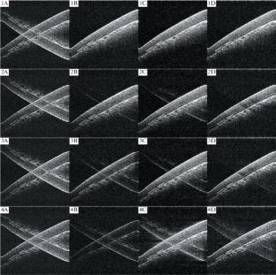 A New Method for Motion Artifact Suppression in Spectral-Domain Optical Coherence Tomography