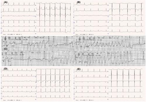 Torsades de pointes due to oral sitafloxacin