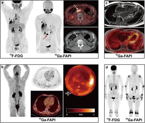 Clinical applications of fibroblast activation protein-targeted theranostics in oncologic and nononcologic disease: Current status and future directions