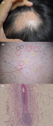 A case of myasthenia gravis following alopecia areata