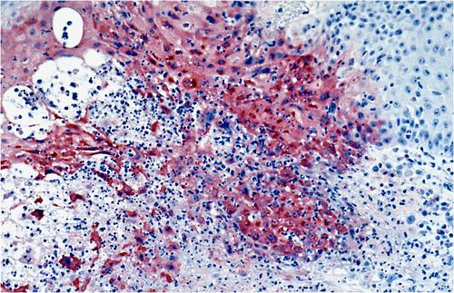 The important role of skin biopsies in the diagnosis of mpox