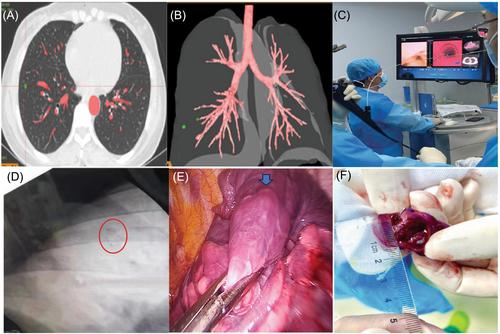 Preoperative pulmonary nodule localization: A comparison of hook wire and Lung-pro-guided surgical markers