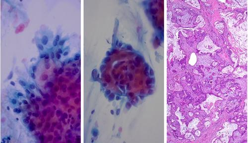 Pleomorphic adenoma with extensive squamous and mucinous metaplasia and a novel MALAT1::PLAG1 fusion gene