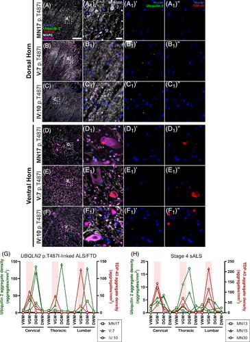 Distribution of ubiquilin 2 and TDP-43 aggregates throughout the CNS in UBQLN2 p.T487I-linked amyotrophic lateral sclerosis and frontotemporal dementia