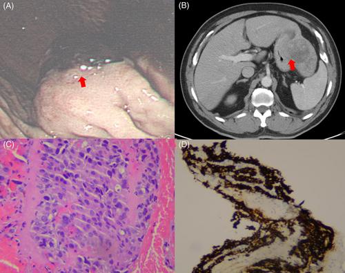 Hepatocellular carcinoma directly invaded the stomach at the time of diagnosis