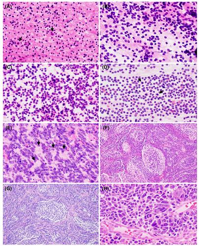 Embryonal and pineal tumours