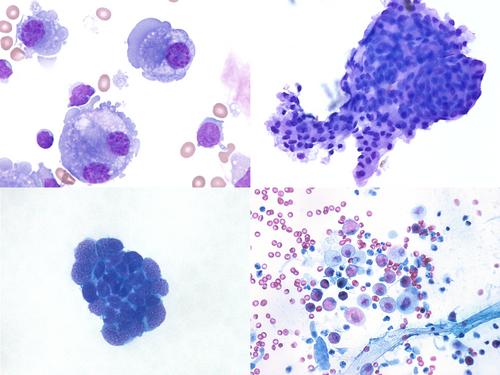 CSF cytology of common primary CNS neoplasms categorized by CNS WHO 2021