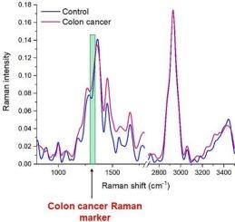 Correlation between human colon cancer specific antigens and Raman spectra. Attempting to use Raman spectroscopy in the determination of tumor markers for colon cancer