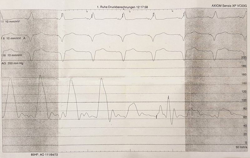 Ascending Aortic Pseudostenosis following the Classic Bentall Inclusion Technique.