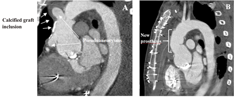 Ascending Aortic Pseudostenosis following the Classic Bentall Inclusion Technique.