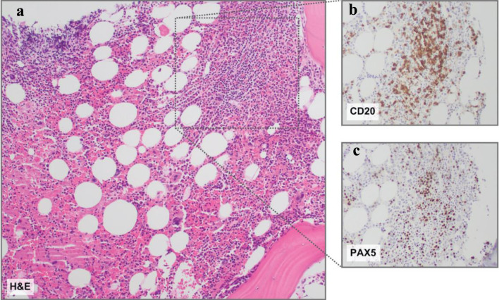 Transformed Plasmablastic Lymphoma Presenting With Marked Lymphocytosis and Spontaneous Tumor Lysis Syndrome.