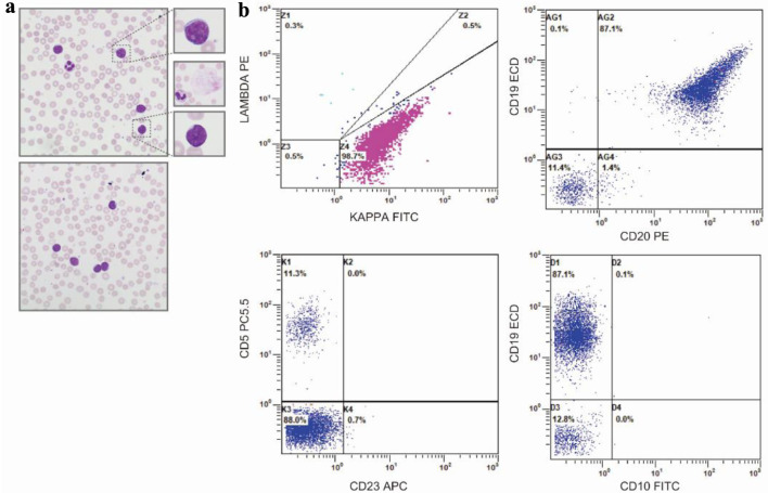 Transformed Plasmablastic Lymphoma Presenting With Marked Lymphocytosis and Spontaneous Tumor Lysis Syndrome.