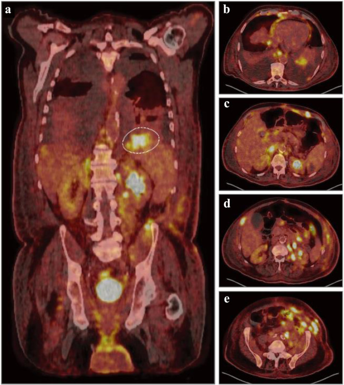 Transformed Plasmablastic Lymphoma Presenting With Marked Lymphocytosis and Spontaneous Tumor Lysis Syndrome.