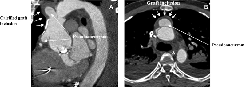 Ascending Aortic Pseudostenosis following the Classic Bentall Inclusion Technique.