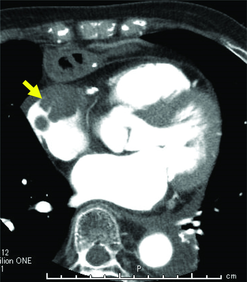 Solitary Cardiac Metastasis from Esophageal Cancer.