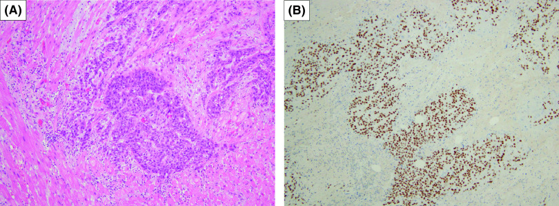 Solitary Cardiac Metastasis from Esophageal Cancer.