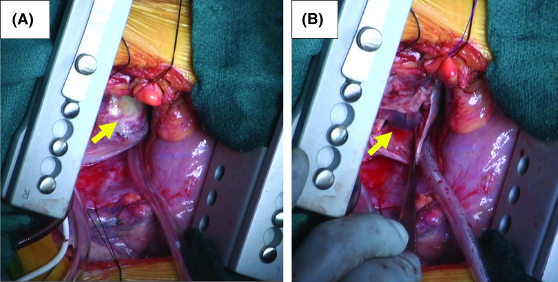 Solitary Cardiac Metastasis from Esophageal Cancer.