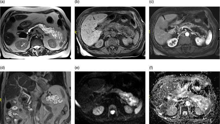 Pancreatic colloid adenocarcinoma arising from intraductal papillary mucinous neoplasm: Radiologic-pathologic correlation with cinematic rendering.