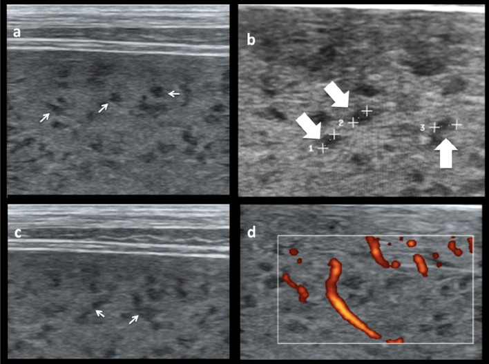 "Sponge pattern" of the spleen: a rarely described high-frequency ultrasound pattern in HIV-positive patients.