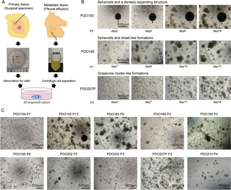 Transcriptomic intratumor heterogeneity of breast cancer patient-derived organoids may reflect the unique biological features of the tumor of origin.