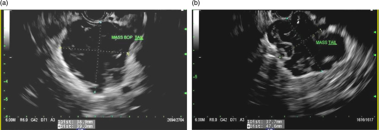 Pancreatic colloid adenocarcinoma arising from intraductal papillary mucinous neoplasm: Radiologic-pathologic correlation with cinematic rendering.