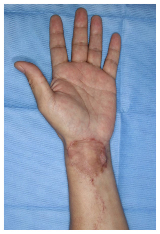 Unusual anomaly of the radial artery encountered during the elevation of a radial forearm free flap: a case report.