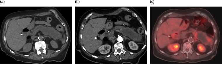 Pancreatic colloid adenocarcinoma arising from intraductal papillary mucinous neoplasm: Radiologic-pathologic correlation with cinematic rendering.