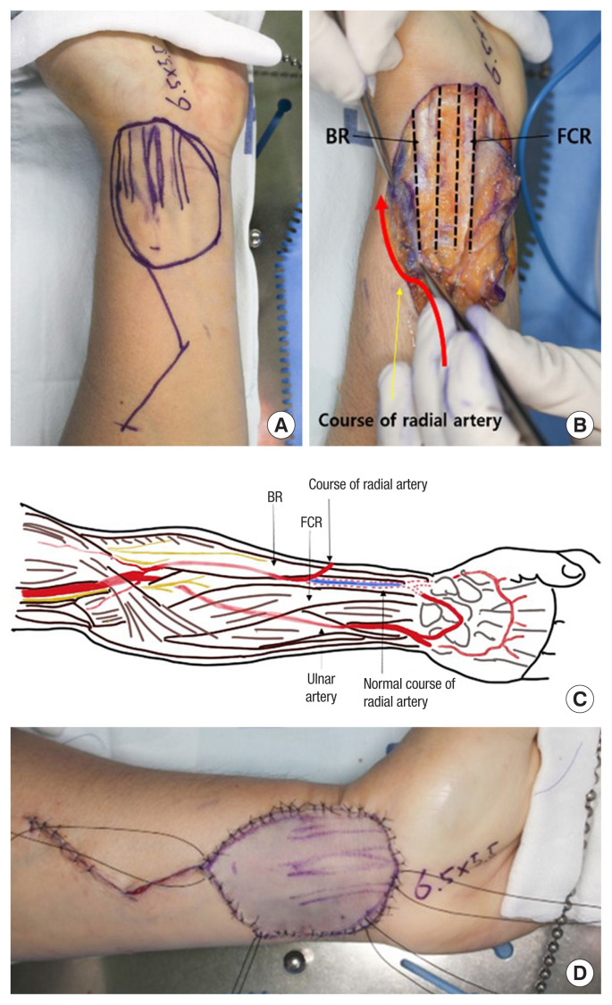 Unusual anomaly of the radial artery encountered during the elevation of a radial forearm free flap: a case report.