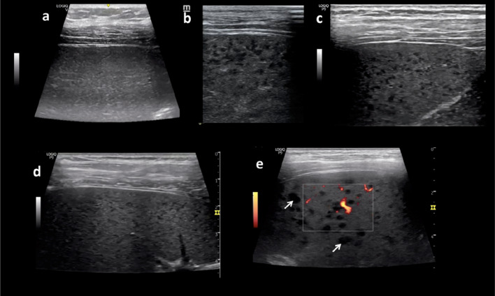 "Sponge pattern" of the spleen: a rarely described high-frequency ultrasound pattern in HIV-positive patients.