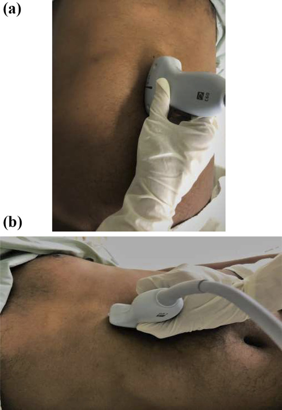 Assessment of residual gastric volume using point-of-care ultrasonography in adult patients who underwent elective surgery.