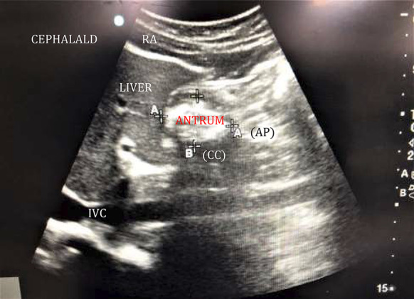 Assessment of residual gastric volume using point-of-care ultrasonography in adult patients who underwent elective surgery.