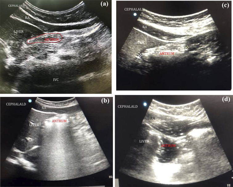 Assessment of residual gastric volume using point-of-care ultrasonography in adult patients who underwent elective surgery.